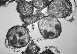 M,2y. | peroxisomes - Zellweger syndrome M,2y. | peroxisomes - Zellweger syndrome